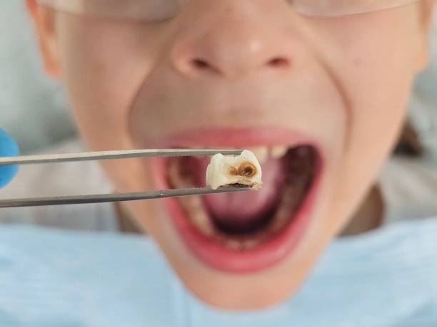 Best Emergency Tooth Extraction in Millville, UT